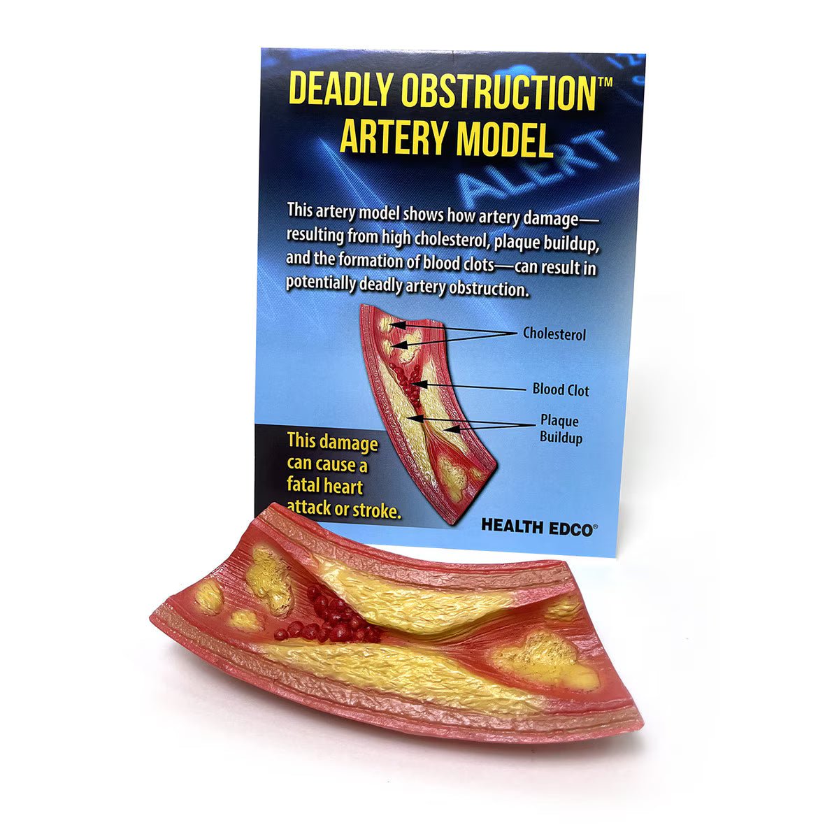 Deadly Obstruction™ Artery Model | Healthcare Training Model - Buy Medical Supplies Online Canada