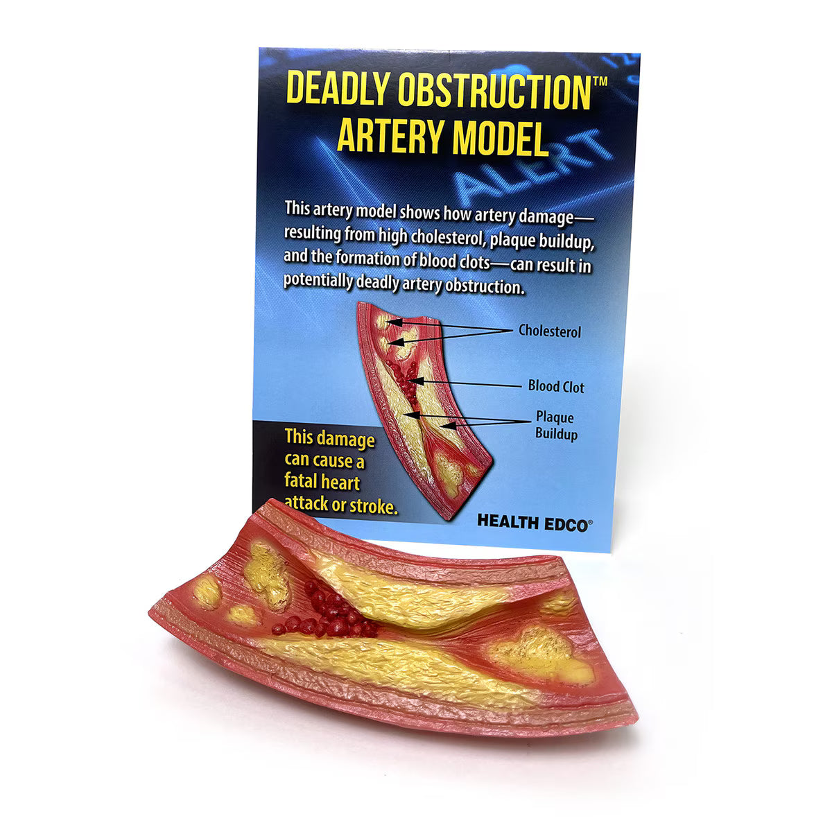 Deadly Obstruction™ Artery Model – 3-D Heart Health Display-Teaching Aids-Birth Supplies Canada