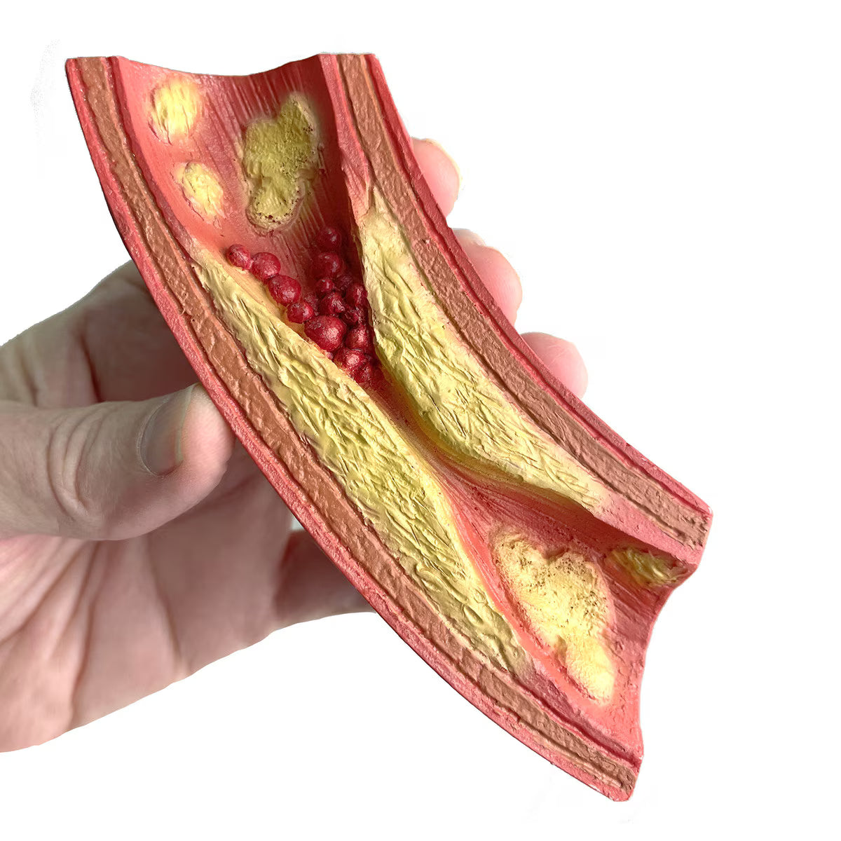 Deadly Obstruction™ Artery Model – 3-D Heart Health Display-Teaching Aids-Birth Supplies Canada