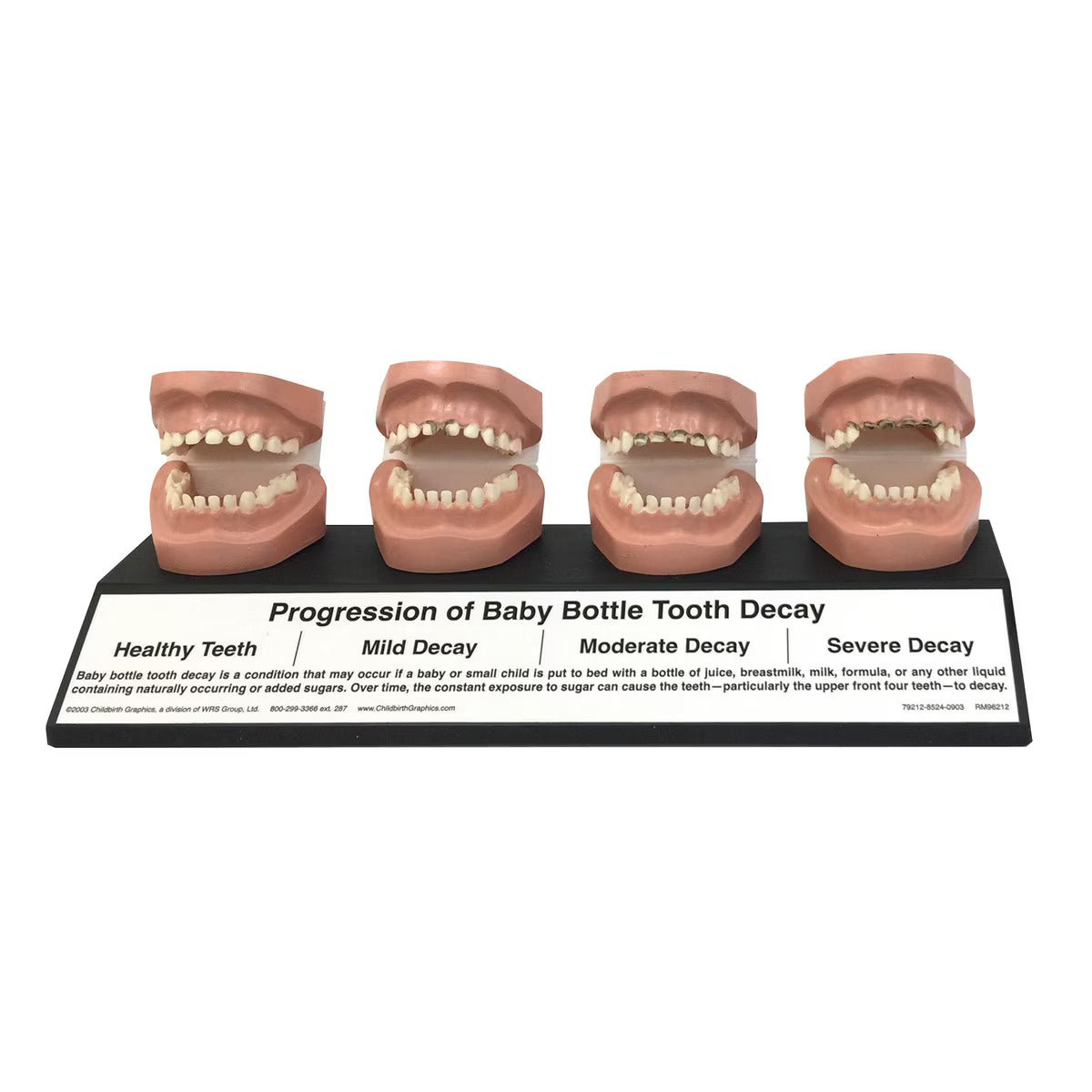 Progression Of Baby Bottle Tooth Decay Display | Healthcare Training Model - Buy Medical Supplies Online Canada