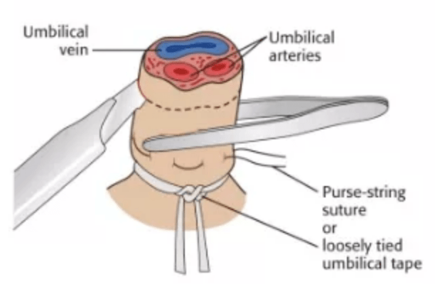 Umbilical Vein Catheterization (UVC) Kit-Emergency Supplies-Birth Supplies Canada