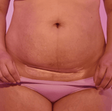 FridaMom C - Section Silicone Scar Patches - Buy Medical Supplies Online Canada