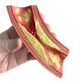 Deadly Obstruction™ Artery Model | Healthcare Training Model - Buy Medical Supplies Online Canada