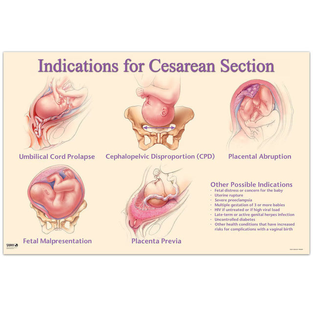 Indications for Cesarean Section Chart - Buy Medical Supplies Online Canada