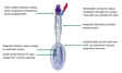 Infant LMA Air-Q-Medical Supplies-Birth Supplies Canada