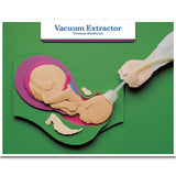 Labour & Birth Intervention Chart Set – Bilingual English/Spanish - Buy Medical Supplies Online Canada