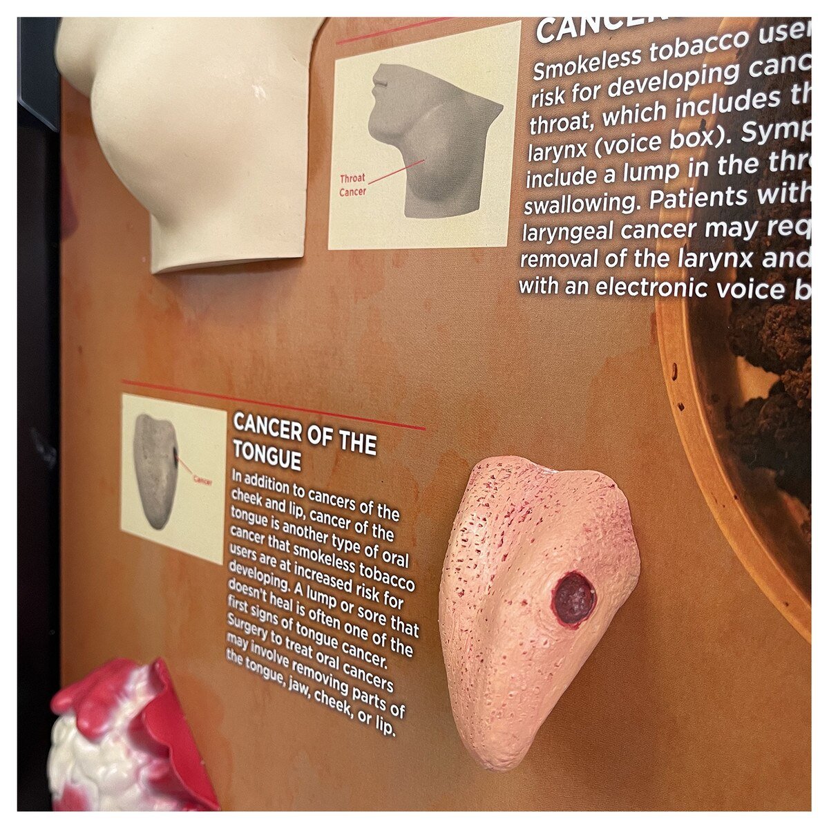 Smokeless Tobacco Consequences 3-D Display-Teaching Aids-Birth Supplies Canada