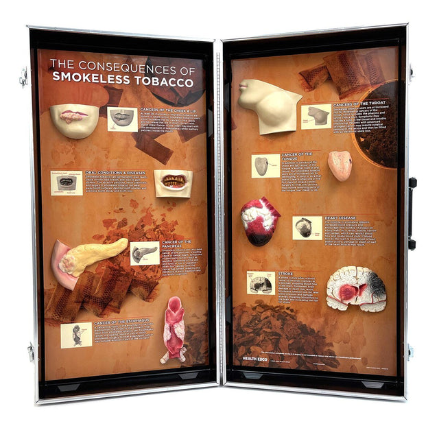 Smokeless Tobacco Consequences 3-D Display-Teaching Aids-Birth Supplies Canada